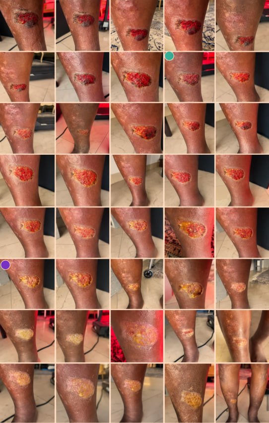 Day-by-day photographic record of a severe leg ulcer healing, from Manuka honey through royal jelly
